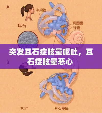 突發(fā)耳石癥眩暈嘔吐，耳石癥眩暈惡心 